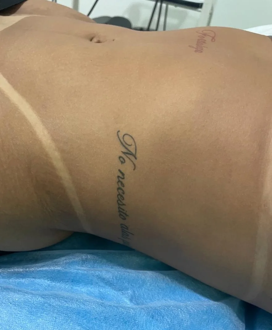 Caso 2 corporal: antes