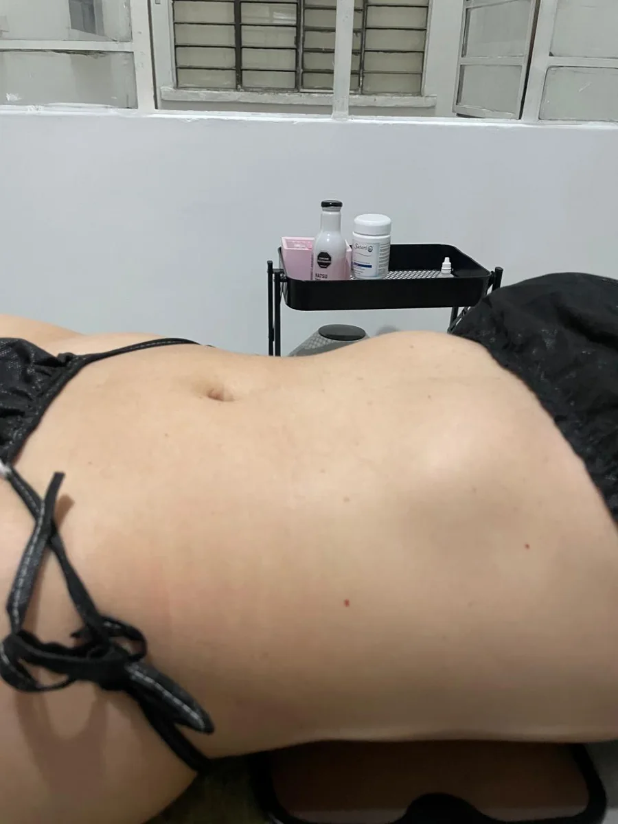 Caso 3 corporal: antes