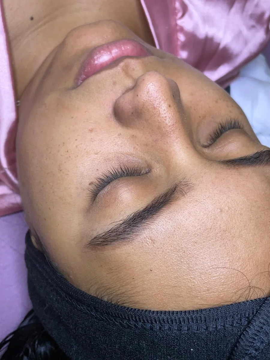 Caso 1 facial: antes
