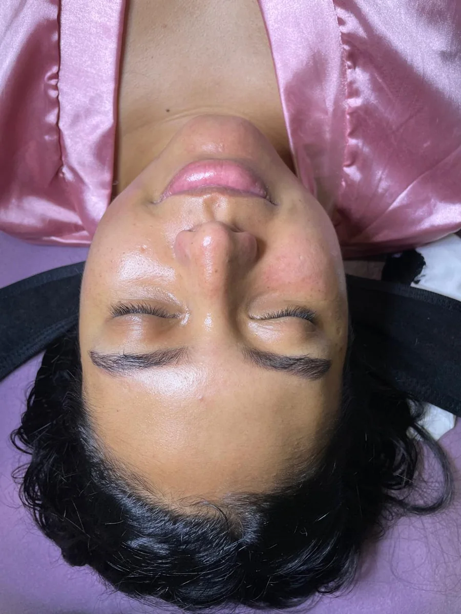 Caso 1 facial: después