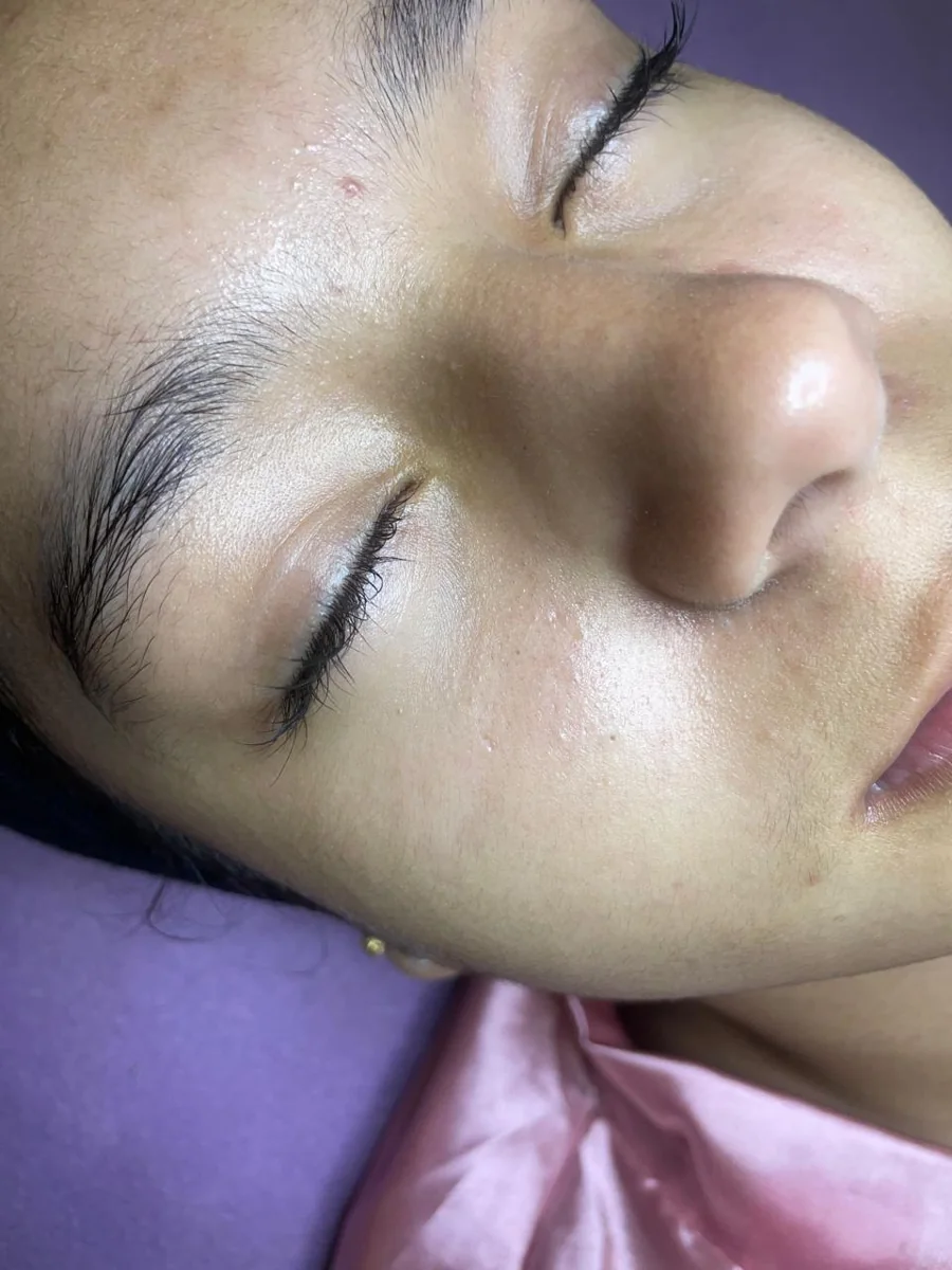 Caso 2 facial: antes