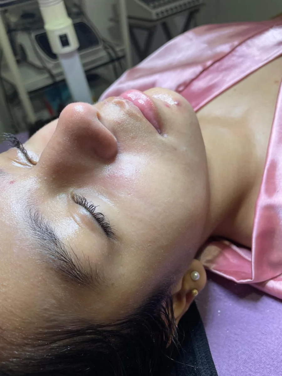 Caso 2 facial: después