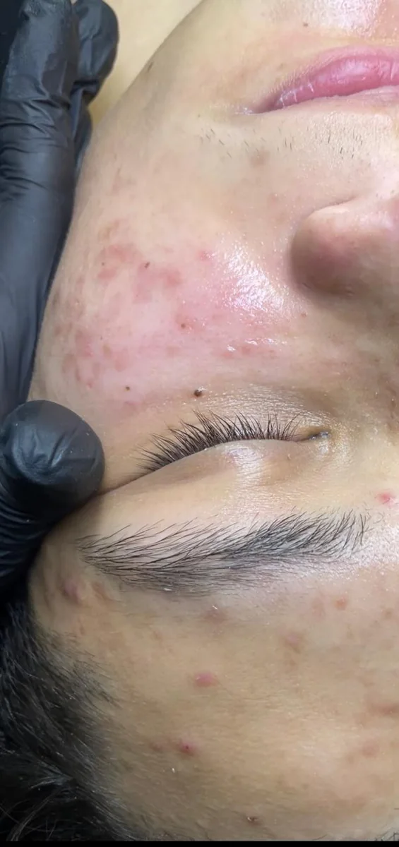 Caso 3 facial: después