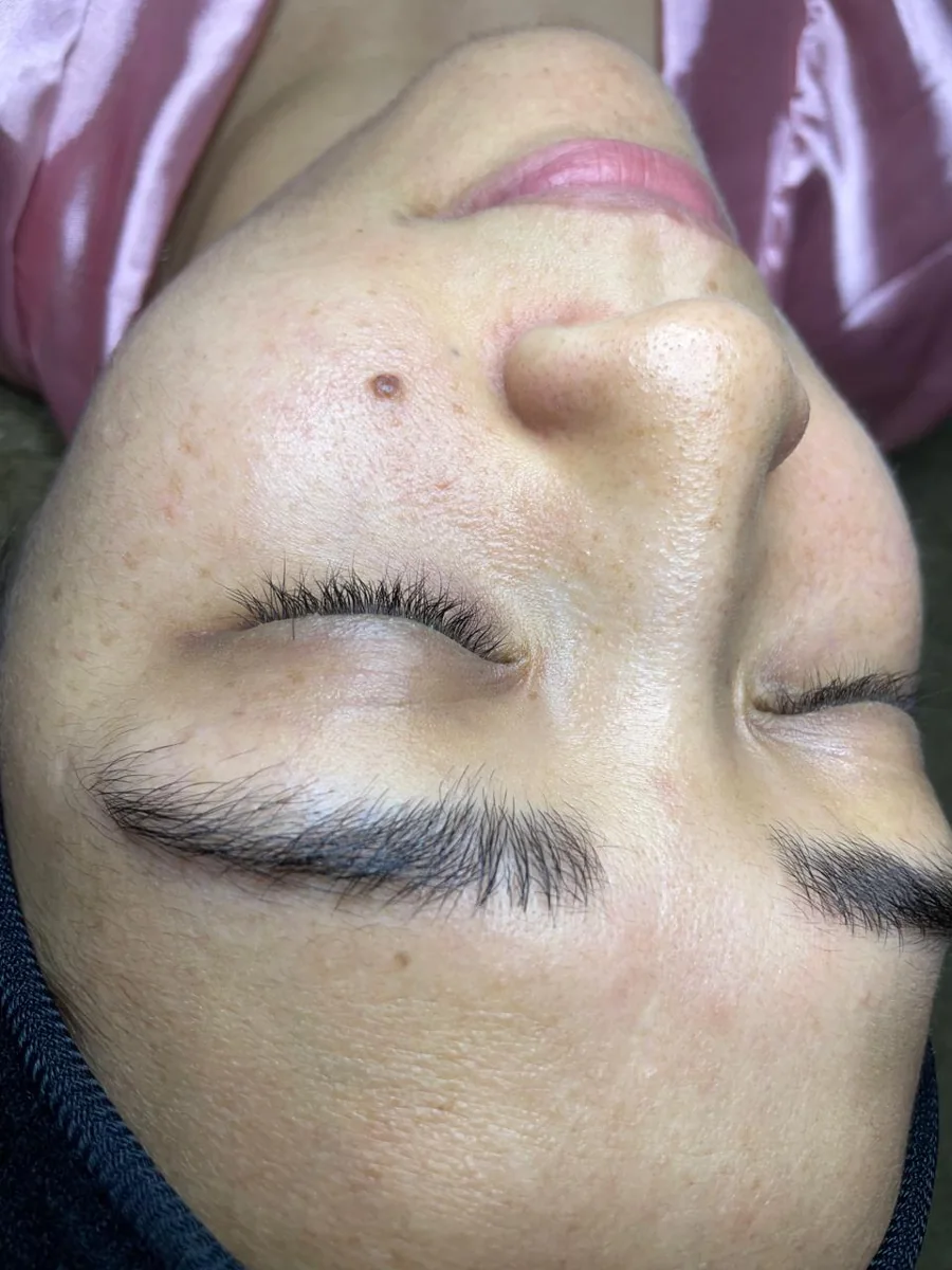 Caso 4 facial: antes