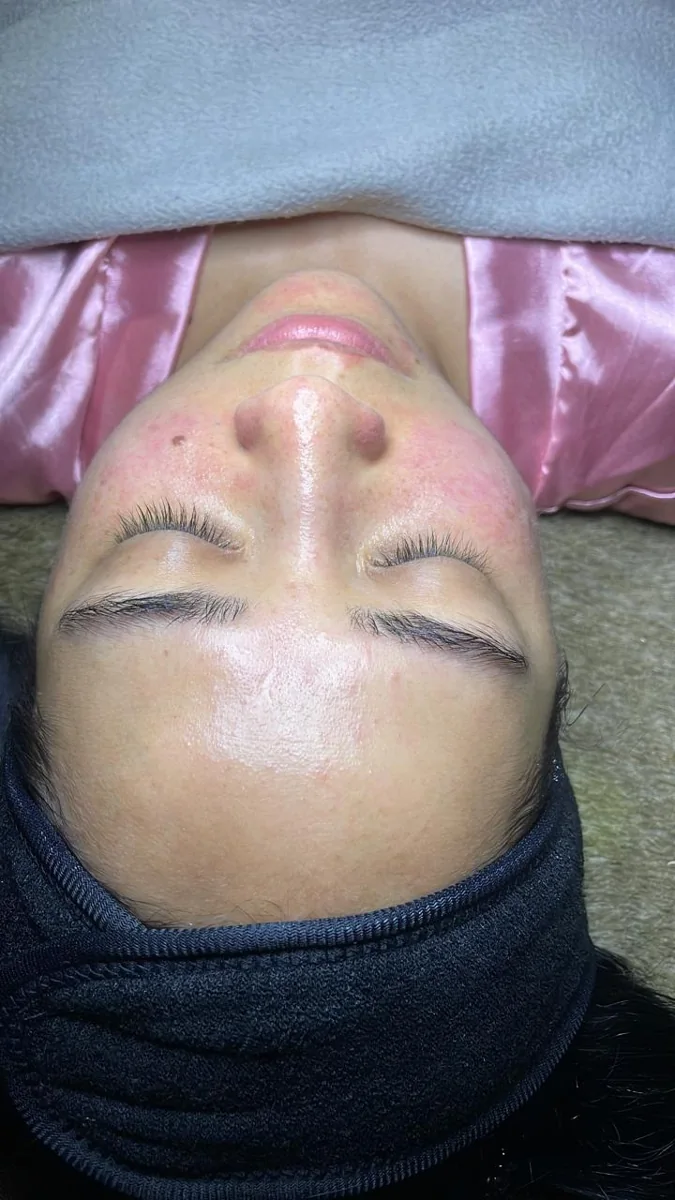 Caso 4 facial: después