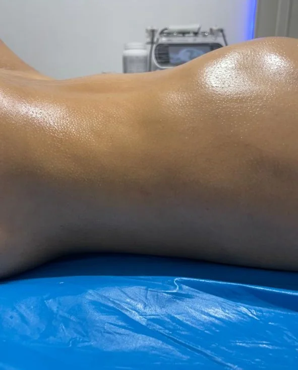 Caso 3 de acompañamiento de seroma: evolución