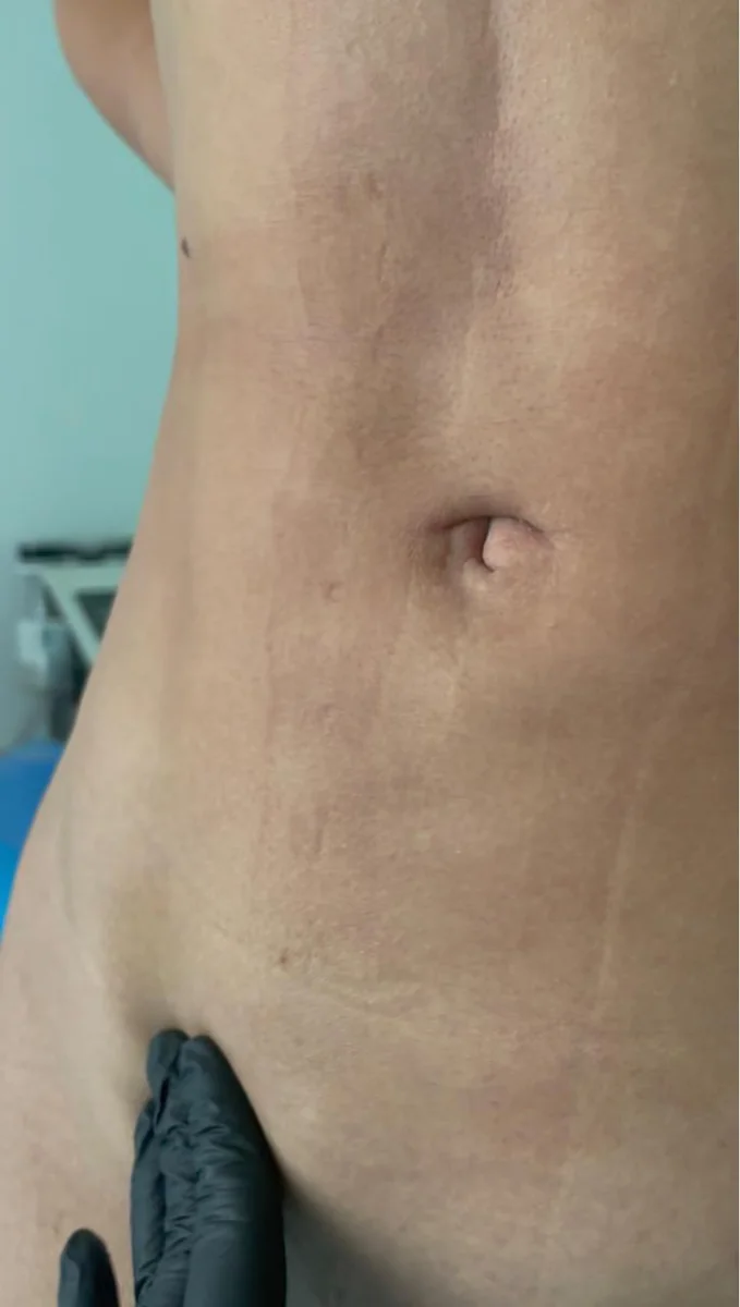 Caso 3 de acompañamiento de seroma: inicio